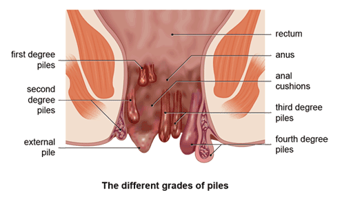 piles surgery in ahmedabad
