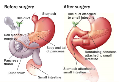 Pancreas Surgery in Ahmedabad